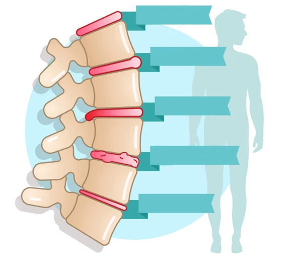 Grad der Thorax -Osteochondrose -Erkrankung
