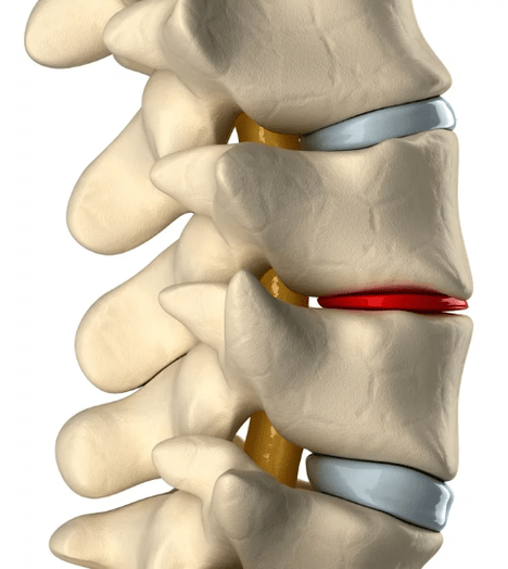 Osteochondrose der Brustsäule