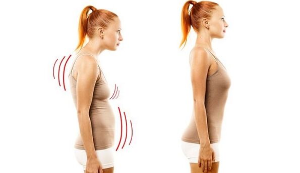 gerader Rücken und schlechte Körperhaltung mit zervikaler Osteochondrose