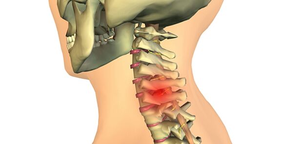 Veränderungen der Wirbelsäule bei zervikaler Osteochondrose