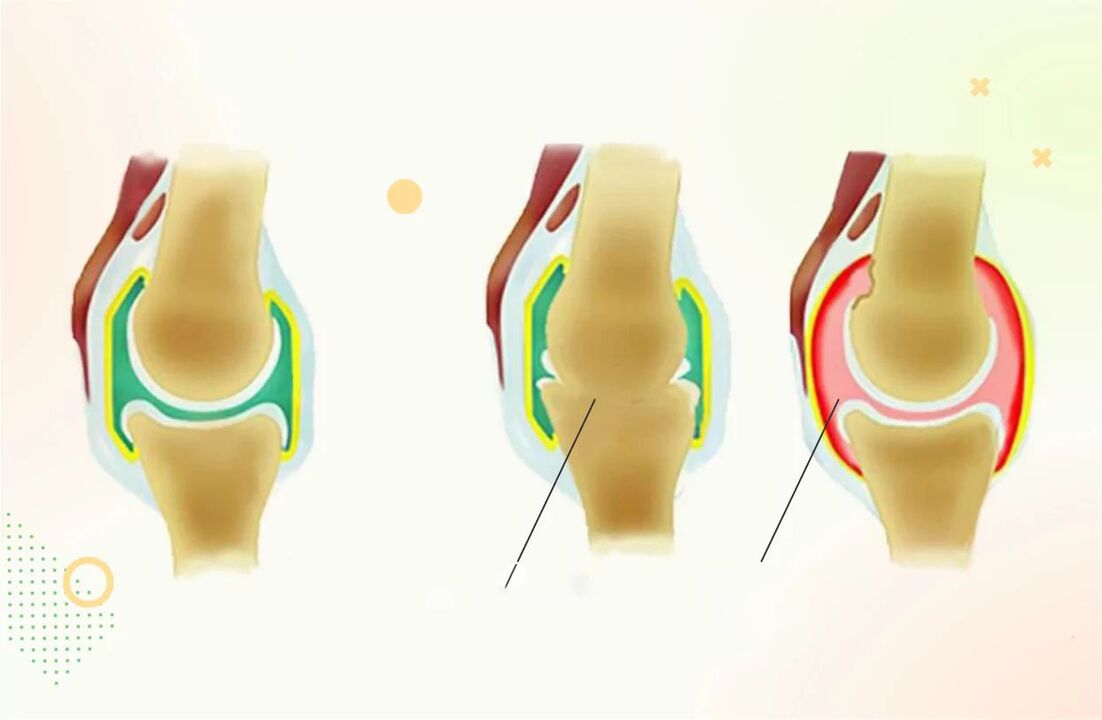 Arthritis und Arthrose